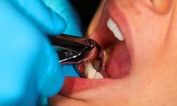 Diş çekimi sonrası implant ne zaman yapılabilir?