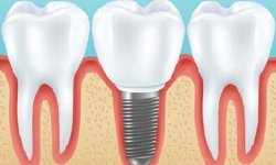 Diş implantı neden tercih edilir?