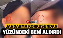 Jandarma korkusundan yüzündeki beni aldırdı