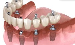 All-on-Six implant treatment in Antalya