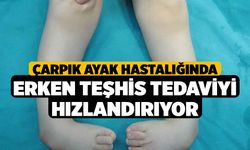 Çarpık ayak hastalığında erken teşhis tedaviyi hızlandırıyor