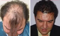 Troy Hair Saç Ekim