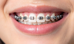 Diş Teli Fiyatları Ne Kadar? (2025 Güncel Rehber)