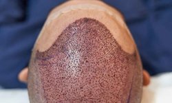 Saç ekimi fiyatları hangi kriterlere göre değişir?