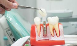 İmplant Tedavisinde Dentoniks Ayrıcalığını Nasıl Yaşarsınız?