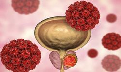 Kötü Huylu Prostat Kanseri Tedavisi: Prostat Kanseri Tedavisi ve Prostat Kanseri Cerrahisi Hakkında Bilmeniz Gerekenler