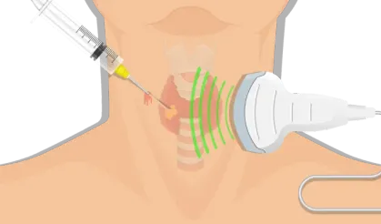 Biyopsi Nedir ve Hangi Durumlarda Yapılır?