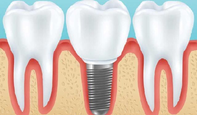 Diş implantı neden tercih edilir?