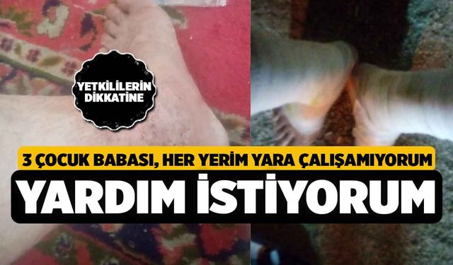 Denizli'de 3 Çocuklu Baba; Her Yerim Yara İçinde, Çaresizim Yardım Edin!