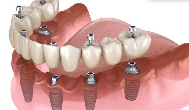 All-on-Six implant treatment in Antalya