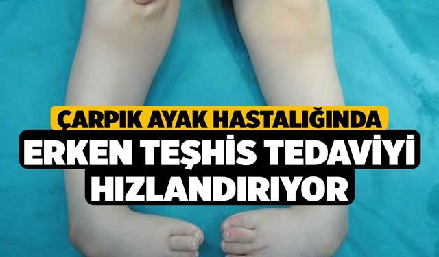 Çarpık ayak hastalığında erken teşhis tedaviyi hızlandırıyor