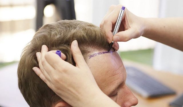 Troy Hair 터키 모발이식