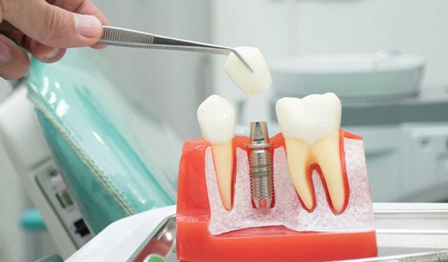 İmplant Tedavisinde Dentoniks Ayrıcalığını Nasıl Yaşarsınız?