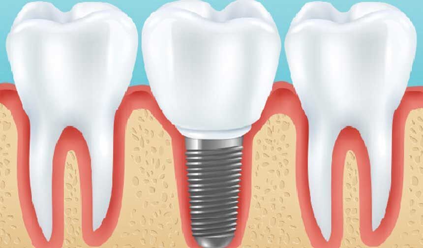 Diş implantı neden tercih edilir?