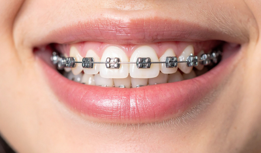 Diş Teli Fiyatları Ne Kadar? (2025 Güncel Rehber)