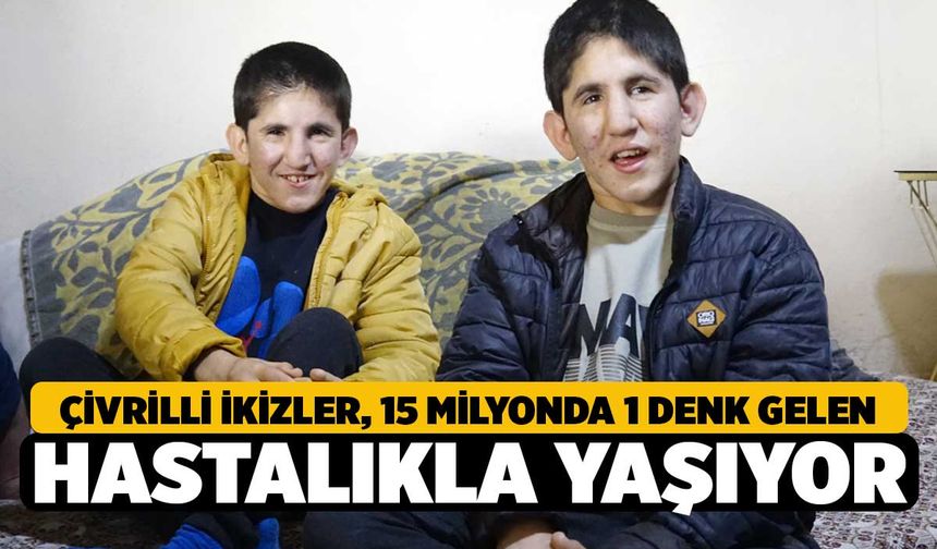 Çivrilli İkizler, 15 Milyonda 1 Görülen Hastalıkla Yaşıyor