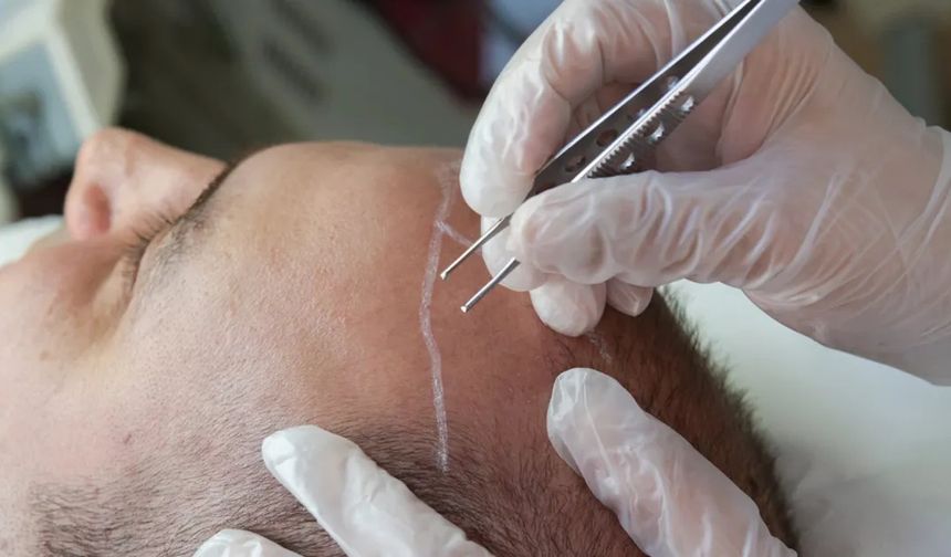 En İyi Saç Ekim Kliniği: Fibroblast Destekli İyileşme ve Hassas Saç Ekimi