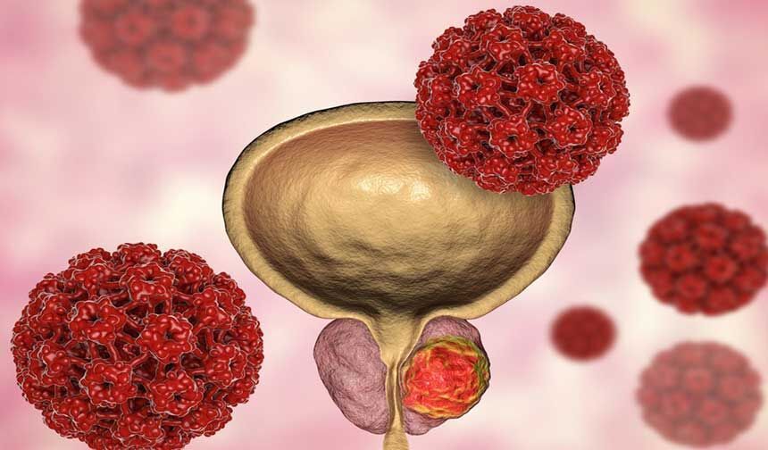 Kötü Huylu Prostat Kanseri Tedavisi: Prostat Kanseri Tedavisi ve Prostat Kanseri Cerrahisi Hakkında Bilmeniz Gerekenler