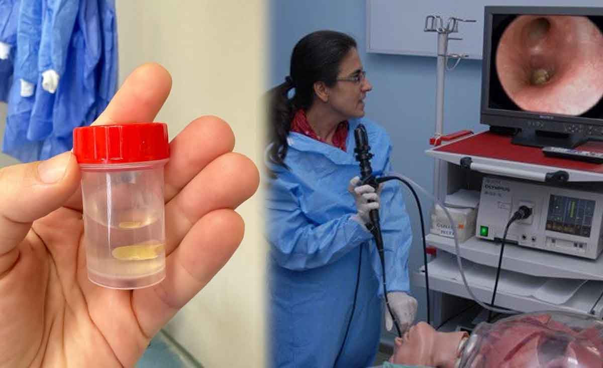 Nefes Borusuna Kacan Misir Tanesi 5 Ay Sonra Ortaya Cikti 1