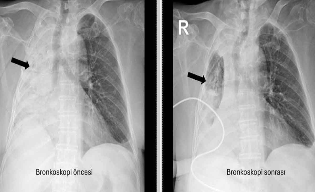 Nefes Borusuna Kacan Misir Tanesi 5 Ay Sonra Ortaya Cikti 2