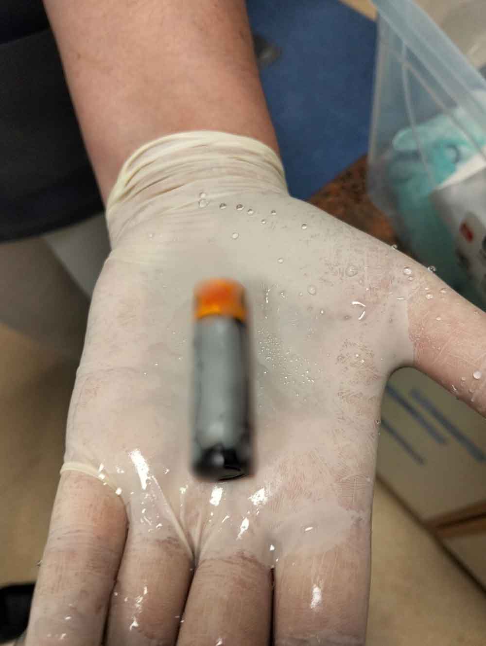 Denizlide 39 Yasindaki Hastanin Midesinden Pil Cikarildi 2